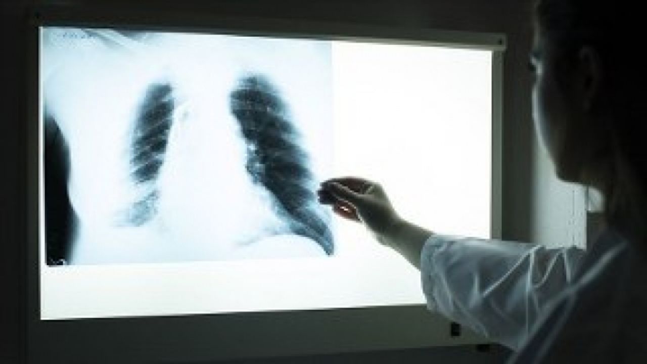 Kovid-19'da akciğer tutulumunun yaygınlığı kişiden kişiye değişiyor