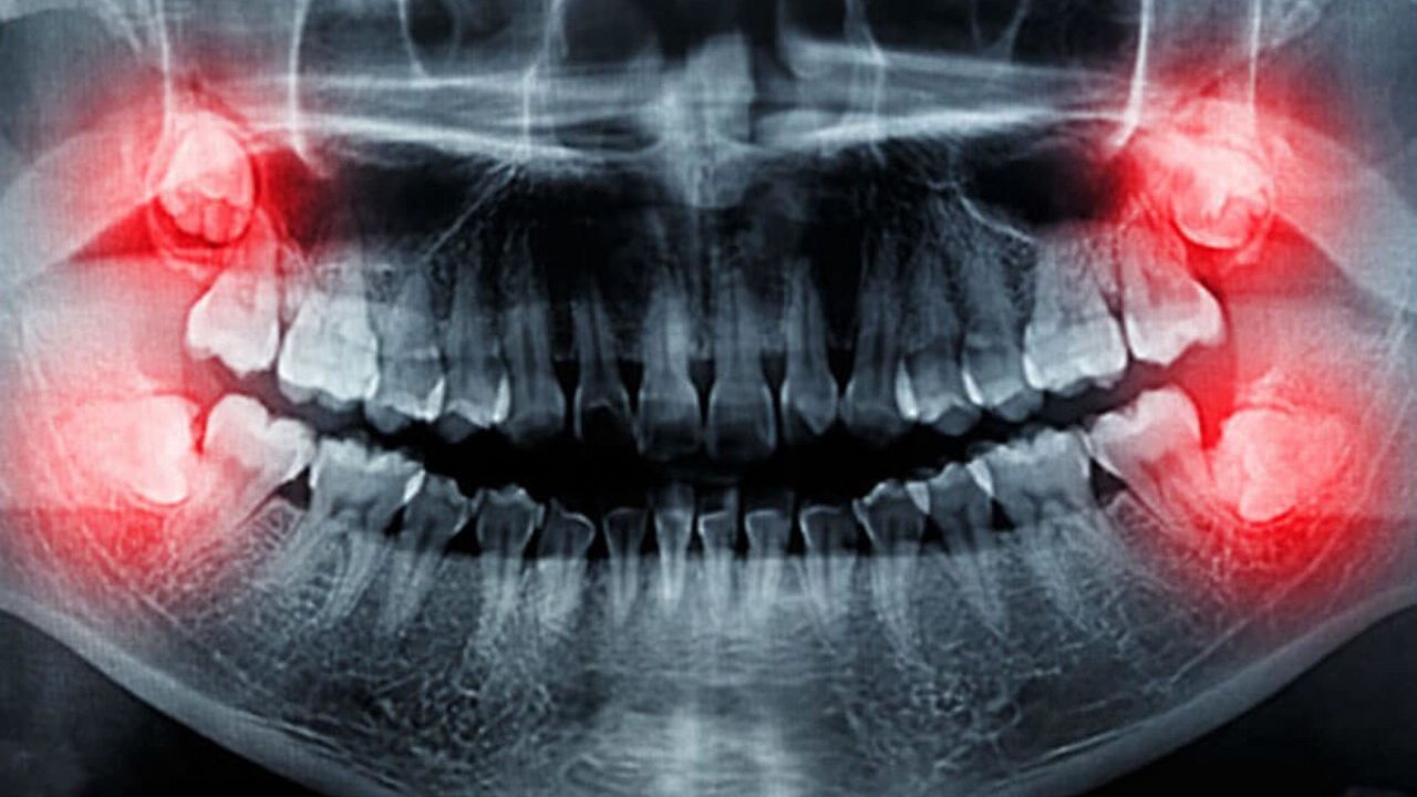 20’lik dişleriniz size sorun mu çıkartıyor?