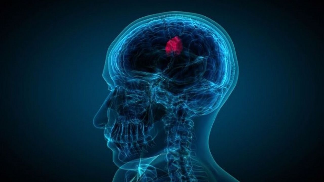 Riskli ve sinsi: Beyin Sisi Hastalığı