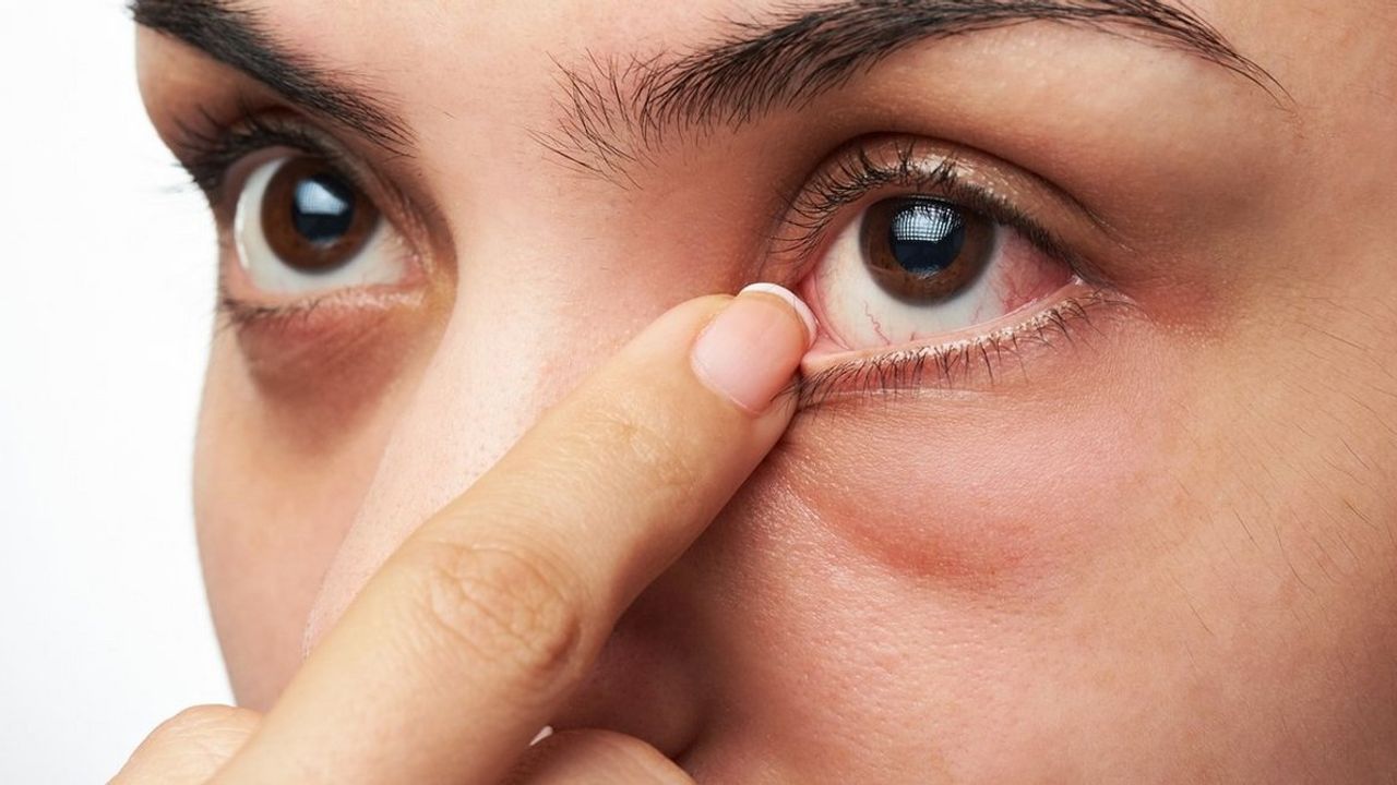 Göz alerjisi ile göz enfeksiyonunu karıştırmayın
