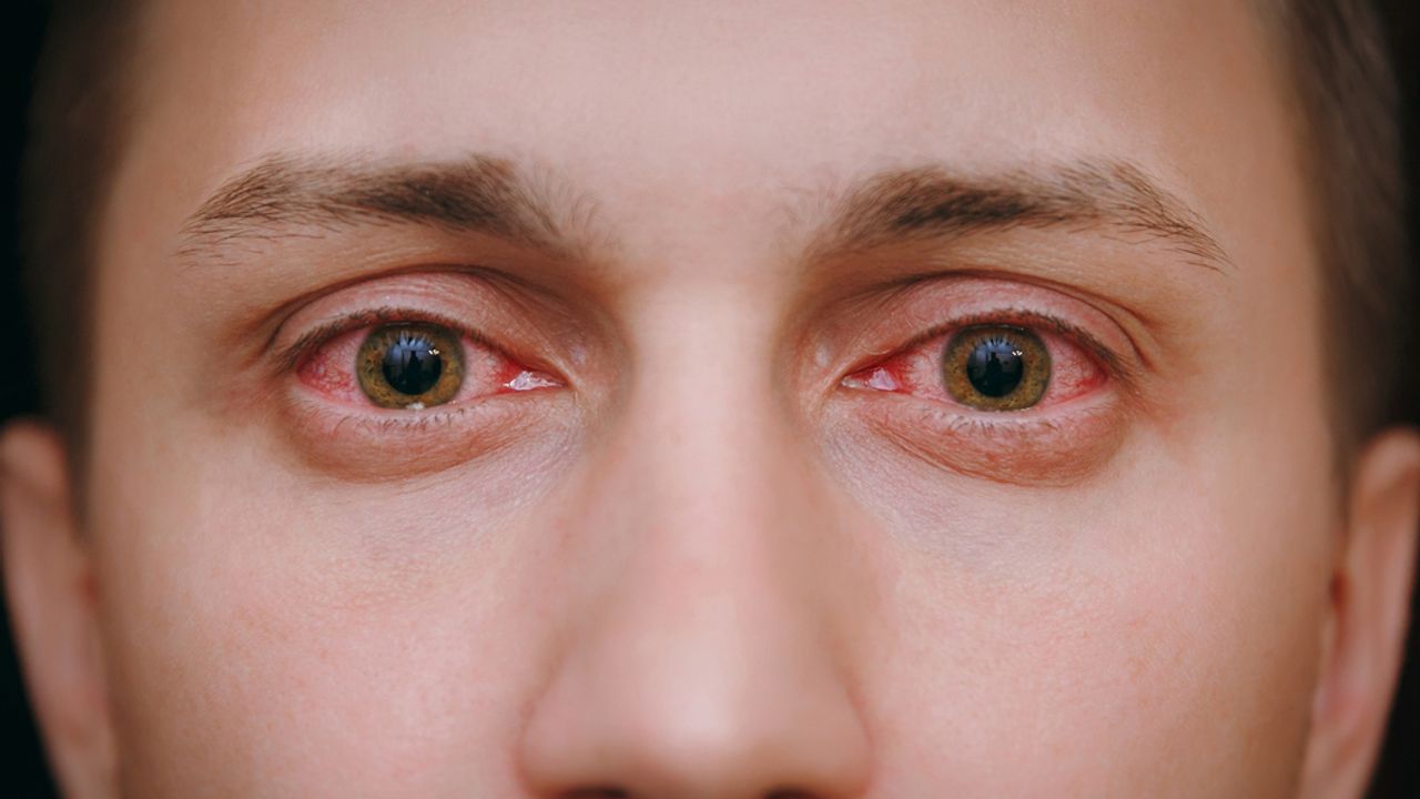 Sinsi Hastalık: Göz tansiyonu glokom nedir?