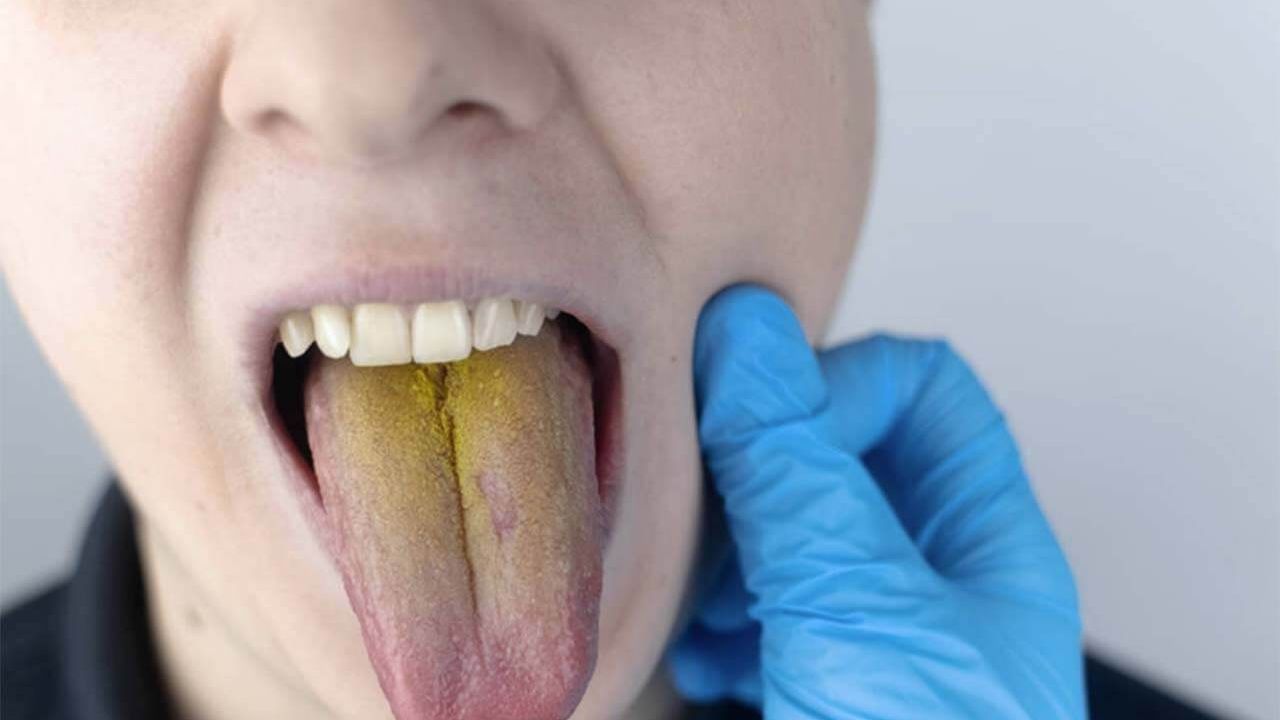 Dilde oluşan renk değişimleri hangi hastalıkların habercisi