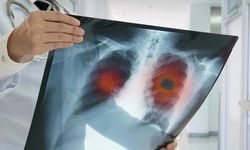 KOAH ve Akciğer Kanseri: Aynı Nefeste İki Ölümcül Tehdit