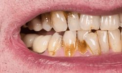 Diş minesini aşındırıyor, ağızdaki bakterileri artırıyor, dişleri çürütüyor, diş erozyonuna ve lekelenmeye neden oluyor!