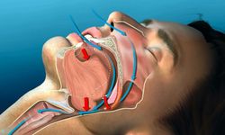 Meğer sebebi buymuş! Horlama ve uyku apnesinde diş hekimlerinin rolü