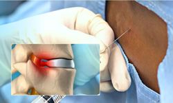 Brezilyalı Bilim İnsanlarından Devrim Niteliğinde Felç Tedavisi: “Polylaminin” ile Umut Doğdu