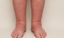 Lenfödem (Fil Hastalığı) Nedir? Erken Tanı Hayat Kurtarıyor!