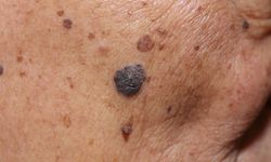 Agresif Tümörün Gizli Sinyali