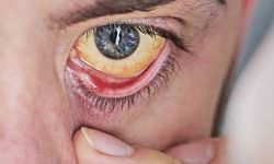 Diyabet Hastalarında Sarı Nokta Hastalığı Tedavisini Kolaylaştıran Keşif!