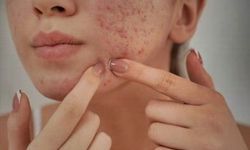 Bilim İnsanları Uyardı: Şiddetli Sivilceler Gençlerde Depresyon Riskini Katlıyor!