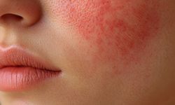 Lupus (Kelebek Hastalığı) Nedir, Belirtileri Nelerdir? İşte Türleri ve Güncel Tedavi Yöntemleri!