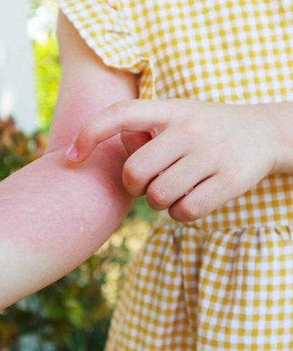 Yaz Tatiliniz Kabusa Dönmesin: Alerji Tetikleyicilerine Karşı Hayat Kurtaran Önlemler