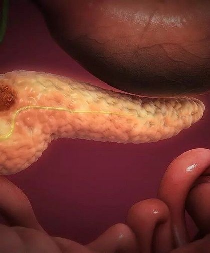 Pankreas Kanserinin Gizli Şifresi Çözüldü!