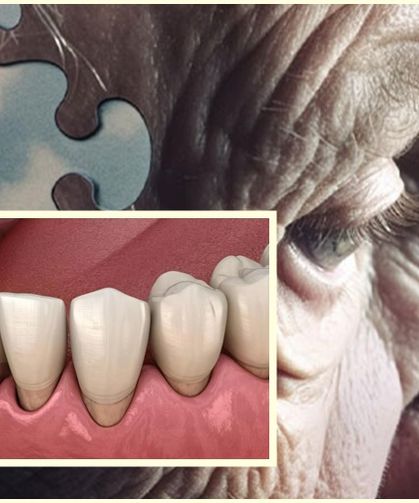 Alzheimer ile Diş Eti Hastalığı Arasında Şaşırtıcı Bağlantı