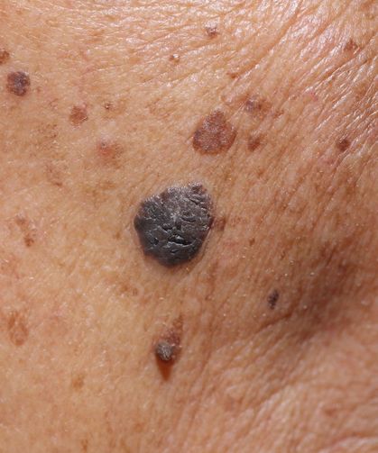 Agresif Tümörün Gizli Sinyali