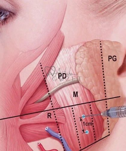 Beklenen Yan Etki Tersine Döndü! Çeneye Yapılan Botoks Tükürüğü Azaltıyor mu?