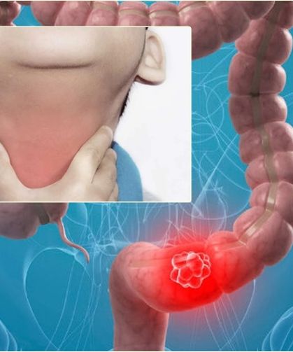 Difteri Toksini Kolon Kanserini Nasıl Durdurdu?