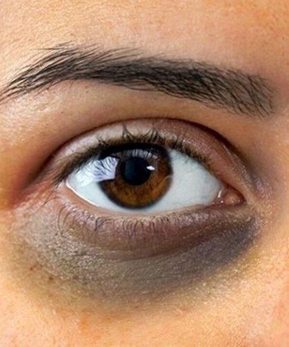 Göz Altı Morlukları Hangi Sağlık Problemlerinin Belirtisi? Tedavi Yolları Neler?