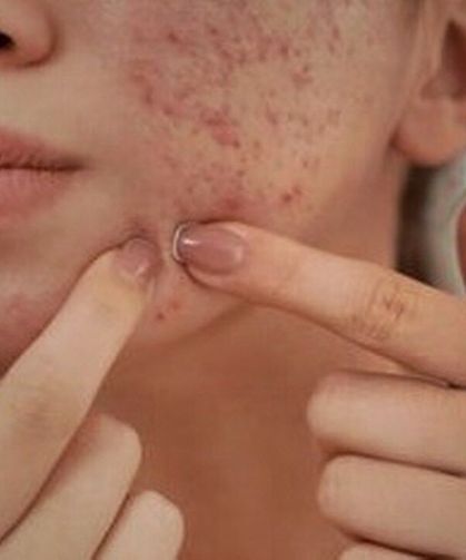 Bilim İnsanları Uyardı: Şiddetli Sivilceler Gençlerde Depresyon Riskini Katlıyor!