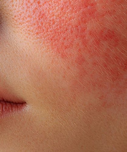Lupus (Kelebek Hastalığı) Nedir, Belirtileri Nelerdir? İşte Türleri ve Güncel Tedavi Yöntemleri!