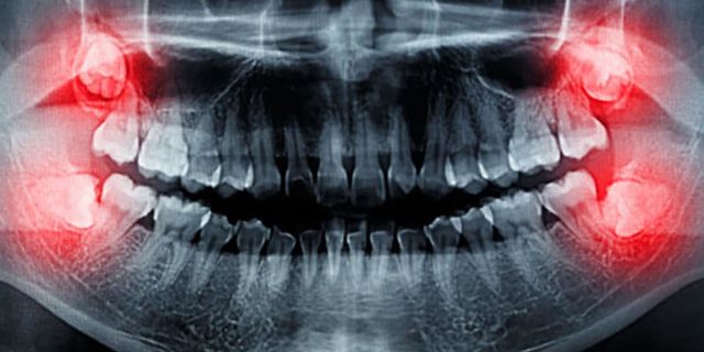 20’lik dişleriniz size sorun mu çıkartıyor?