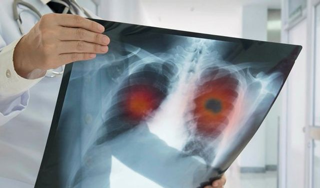 KOAH ve Akciğer Kanseri: Aynı Nefeste İki Ölümcül Tehdit