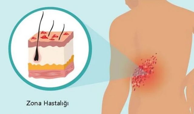 Bugünlerde artış gösteren zona nedir? Nasıl tedavi edilir?