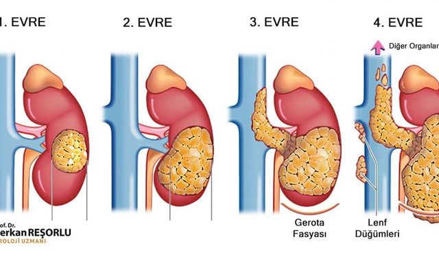 Böbrek kanserinde erken teşhis çok önemli