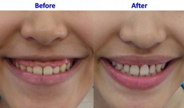 Lip Repositioning işlemi nedir? Hangi durumda kullanılır?