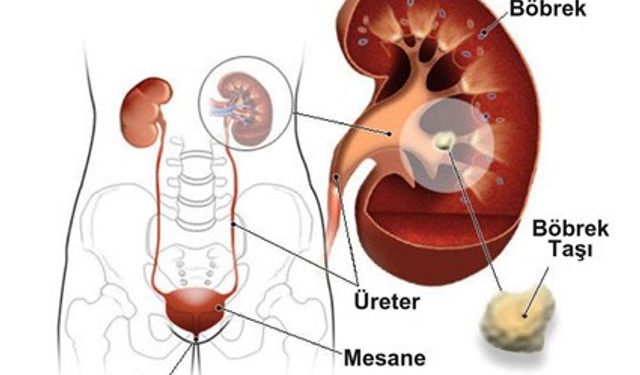 Böbrek Taşları: Sessiz Fakat Ağrılı Bir Rahatsızlık