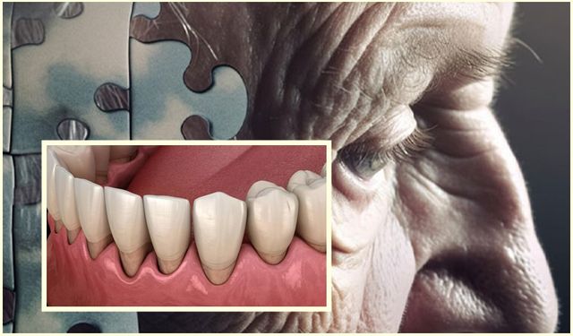 Alzheimer ile Diş Eti Hastalığı Arasında Şaşırtıcı Bağlantı