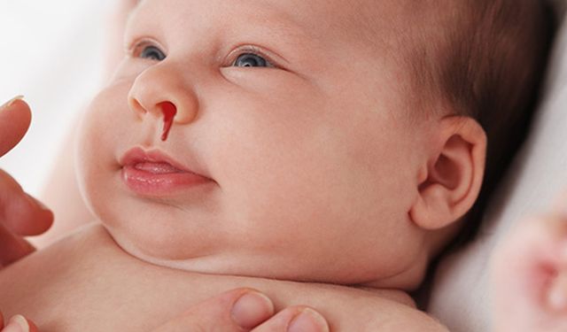 Çocuklarda Burun Kanaması Her Zaman Masum Değil!