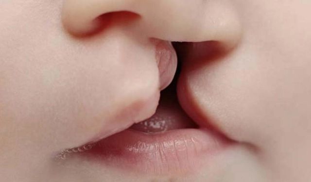 Doğumda Gülümsemeyi Zorlaştıran Sır: Tavşan Dudak