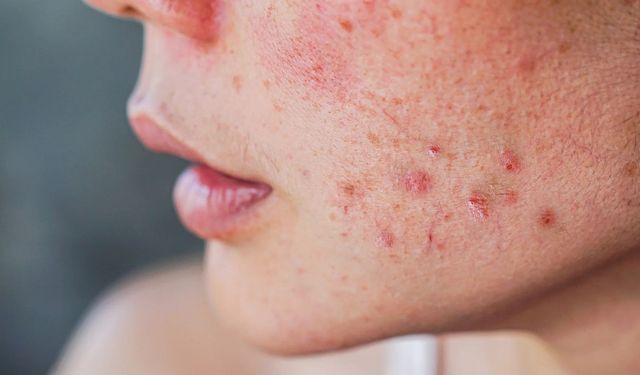 Cilt Alarm Veriyor: Basit Bir Kızarıklık Ciddi Bir Hastalığın Habercisi Olabilir mi?