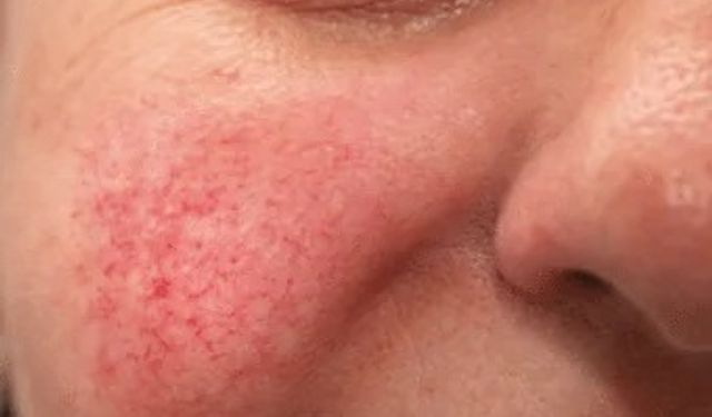 Peteşi: Deri Altındaki Gizli Kanamalar