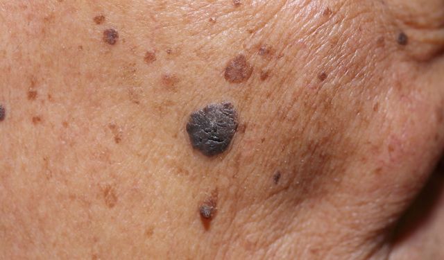 Agresif Tümörün Gizli Sinyali