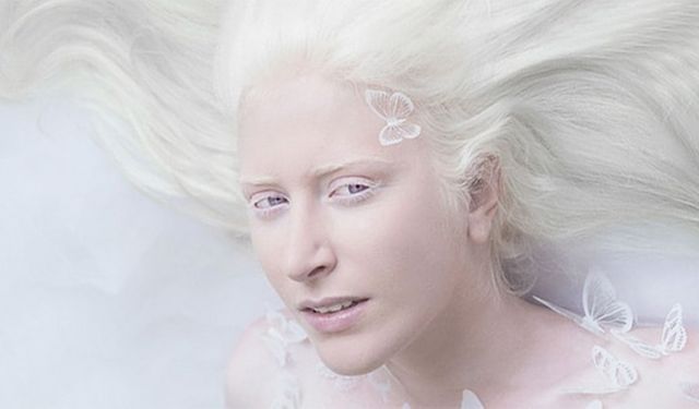 Albinizmde Görme Neden Zayıf?