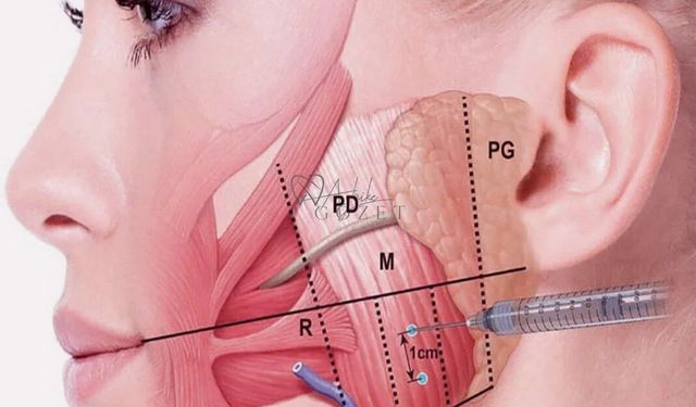Beklenen Yan Etki Tersine Döndü! Çeneye Yapılan Botoks Tükürüğü Azaltıyor mu?