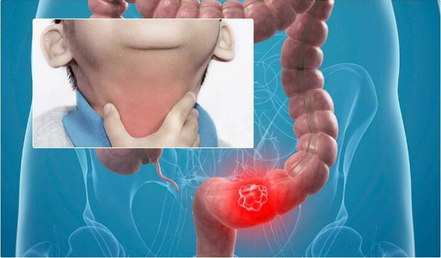 Difteri Toksini Kolon Kanserini Nasıl Durdurdu?