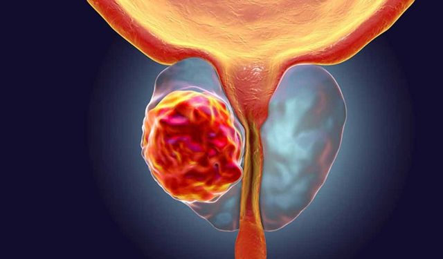 Prostat Kanserinin Moleküler Şifresi Çözülüyor