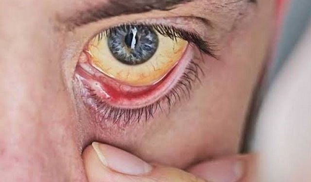 Diyabet Hastalarında Sarı Nokta Hastalığı Tedavisini Kolaylaştıran Keşif!