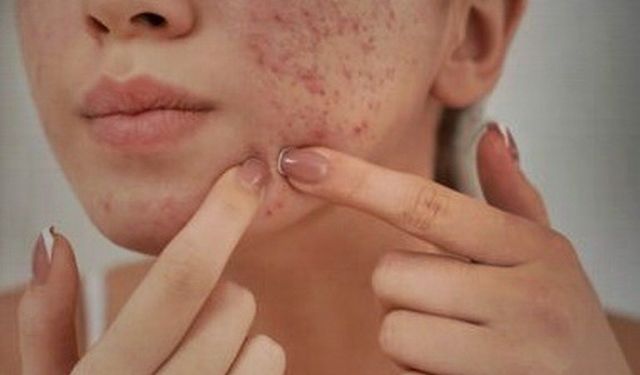 Bilim İnsanları Uyardı: Şiddetli Sivilceler Gençlerde Depresyon Riskini Katlıyor!