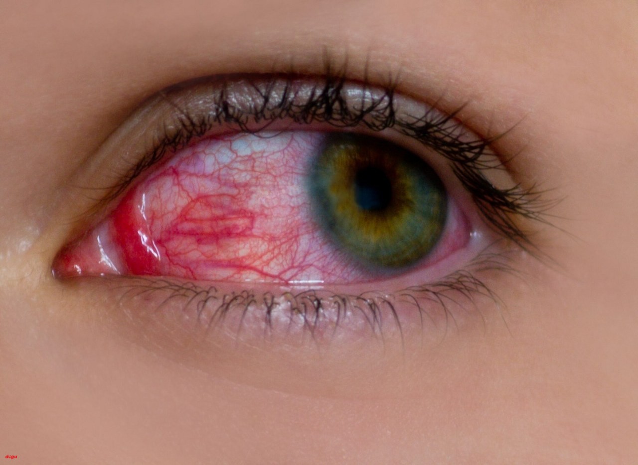kırmızı göz hastalığı (3)_1280x934