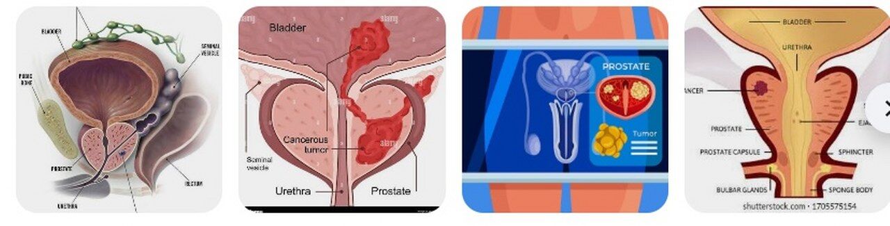 Prostat Kanseri Evreleri Ve Psa Testi